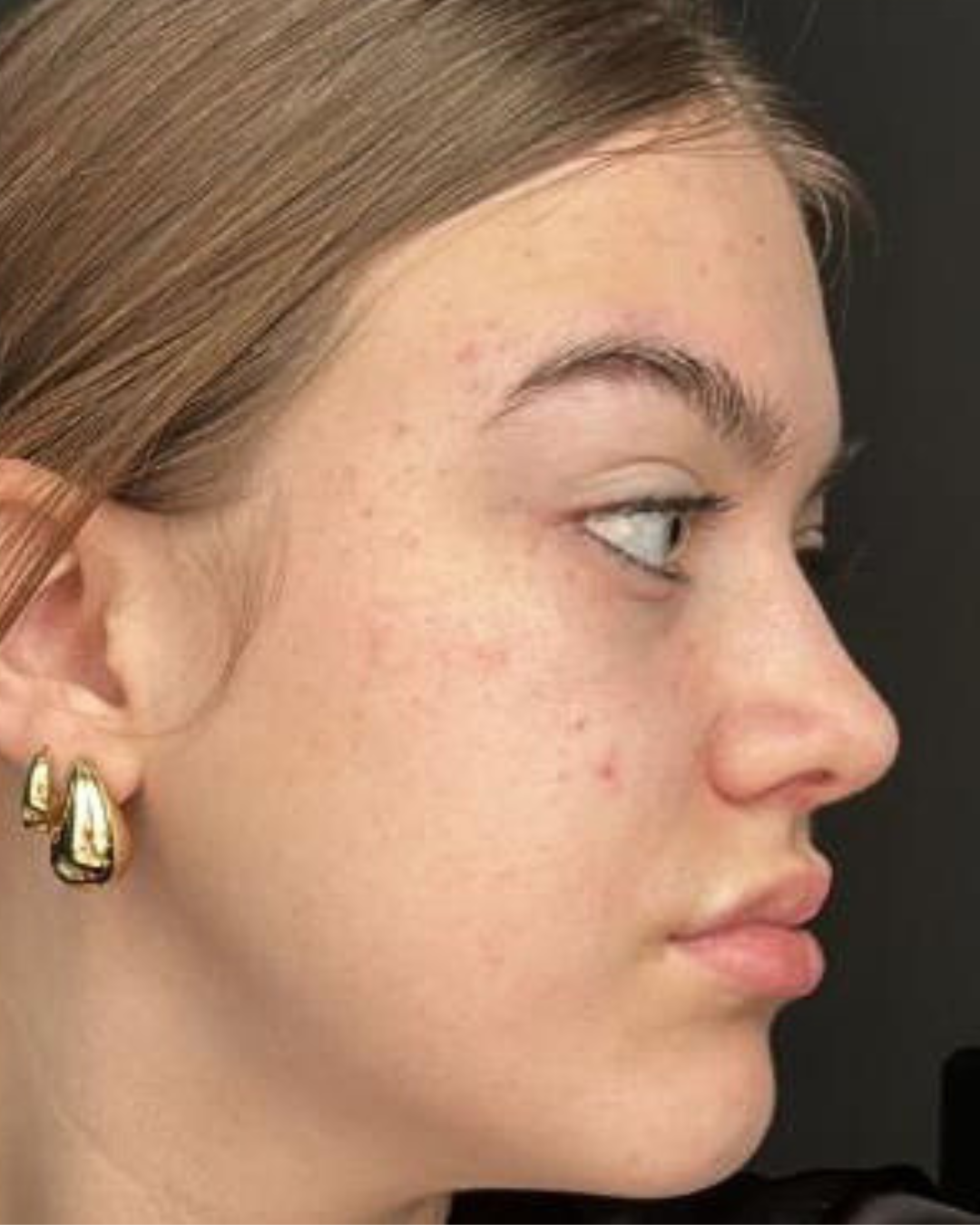 Before Fenix Tallow Acne Huid