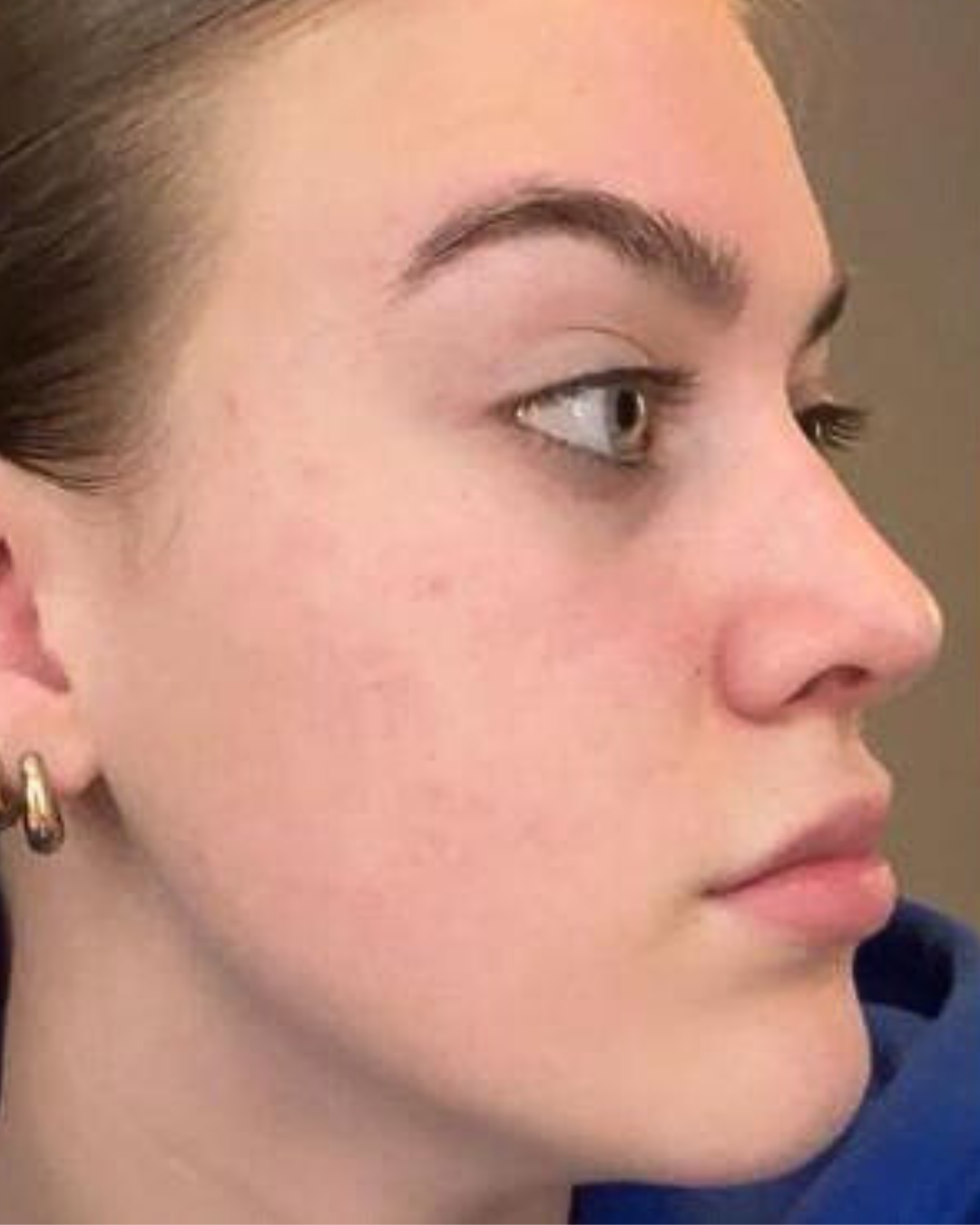 After Foto Fenix Tallow Acne Huid